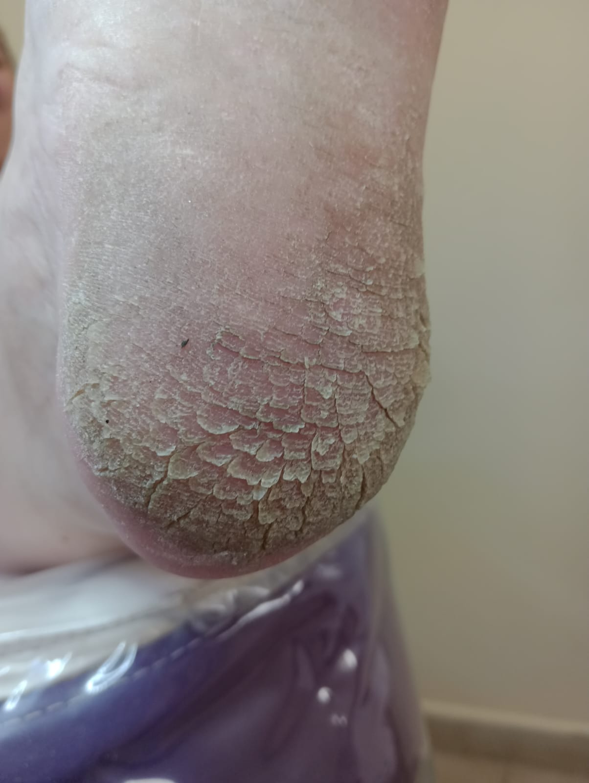 Antes del tratamiento de Talones agrietados